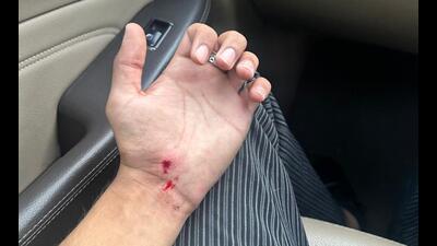 The victim, Kartik Gandhi, a resident of Dera Bassi, sustained multiple injuries after being bitten several times by the dog, allegedly unleashed by its owner. (HR)