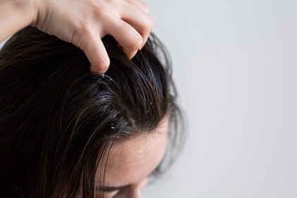 Dandruff is one of the signs your scalp needs a detox. (Freepik) Dandruff is one of the signs your scalp needs a detox. (Freepik)
