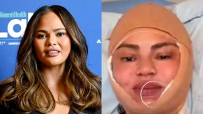Chrissy Teigen opens up about her newest cosmetic procedure Chrissy Teigen opens up about her newest cosmetic procedure