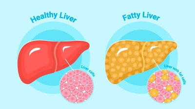 Dr. Wendi highlights the dangers of fatty liver disease, which can progress to fibrosis and chronic liver failure if untreated. (Freepik) Dr. Wendi highlights the dangers of fatty liver disease, which can progress to fibrosis and chronic liver failure if untreated. (Freepik)
