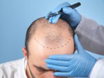 Hair transplant can provide natural-looking results, especially when performed by an experienced surgeon. (Freepik)