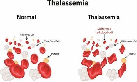 Thalassemia disorder affects the production of hemoglobin and healthy red blood cells (Sourced) Thalassemia disorder affects the production of hemoglobin and healthy red blood cells (Sourced)