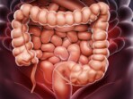 Patients can increase their physical activity after colon cancer treatment.