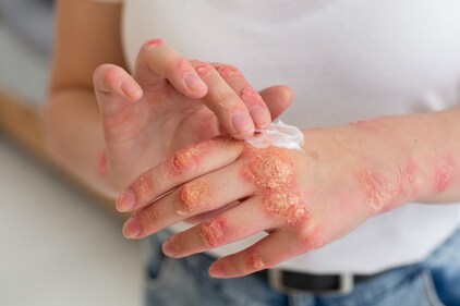 Some skin problems, such as eczema, also get exacerbated by stress. (Freepik) Some skin problems, such as eczema, also get exacerbated by stress. (Freepik)