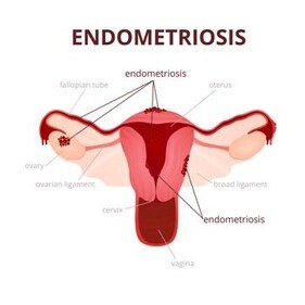 Surgery can be used to remove lesions and relieve the pain of endometriosis, but the risk of recurrence is high for severe cases, at between 5% and 20%. (Shutterstock) Surgery can be used to remove lesions and relieve the pain of endometriosis, but the risk of recurrence is high for severe cases, at between 5% and 20%. (Shutterstock)