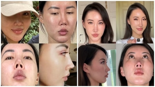 Violet's nose after the first nose job (Left) and her nose after the fifth surgery (Right). (Instagram/@violetvanitypalms) Violet's nose after the first nose job (Left) and her nose after the fifth surgery (Right). (Instagram/@violetvanitypalms)