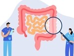 Colorectal Cancer 