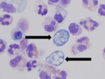 The laboratory testing at CDC confirmed the presence of N. fowleri in the patient’s cerebrospinal fluid.