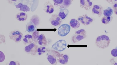 The laboratory testing at CDC confirmed the presence of N. fowleri in the patient’s cerebrospinal fluid. (CDC/Representational Image) The laboratory testing at CDC confirmed the presence of N. fowleri in the patient’s cerebrospinal fluid. (CDC/Representational Image)