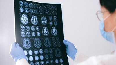 Not all brain tumours are malignant. (Anna Shvets) Not all brain tumours are malignant. (Anna Shvets)
