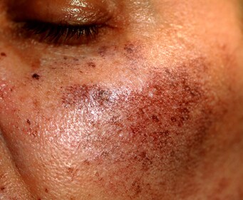 Red marks from sun exposure are a result of chronic inflammation. (Shutterstock) Red marks from sun exposure are a result of chronic inflammation. (Shutterstock)