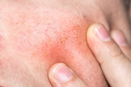 Broken capillaries are seen on the face when exposed to the sun for a longer duration. (Shutterstock) Broken capillaries are seen on the face when exposed to the sun for a longer duration. (Shutterstock)