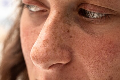 Brown spots on skin become more visible. (Shutterstock) Brown spots on skin become more visible. (Shutterstock)
