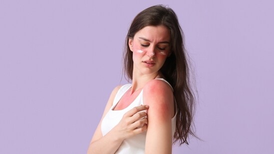 Sunburn is not the only consequence of sun exposure, there are others which are much more concerning. (Shutterstock)