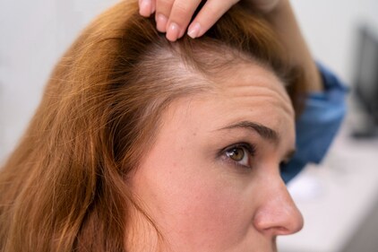 Hair loss can happen for several reasons, and sometimes it's a combination of factors. (Freepik) Hair loss can happen for several reasons, and sometimes it's a combination of factors. (Freepik)