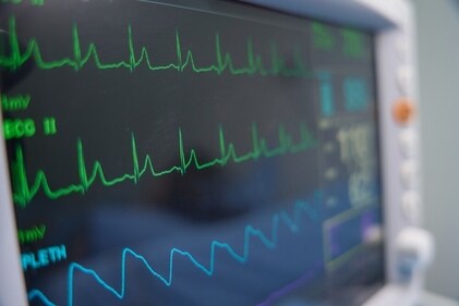 Arrhythmia is when your heartbeats are uneven, like it's skipping a beat or beating too slow or too fast suddenly. (Shutterstock) Arrhythmia is when your heartbeats are uneven, like it's skipping a beat or beating too slow or too fast suddenly. (Shutterstock)