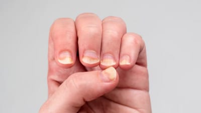 Did you know brittle nails may indicate iron deficiency? Here are some other signs of nutritional deficiencies to watch out for. (Freepik) Did you know brittle nails may indicate iron deficiency? Here are some other signs of nutritional deficiencies to watch out for. (Freepik)