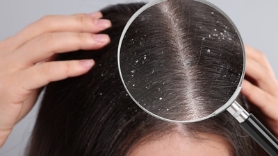 Keep your scalp health in check with the help of appropriate haircare routine. (Shutterstock) Keep your scalp health in check with the help of appropriate haircare routine. (Shutterstock)
