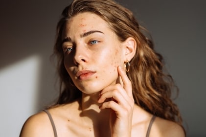 You may get acne near the jaw. (Picture credit: Shutterstock) You may get acne near the jaw. (Picture credit: Shutterstock)