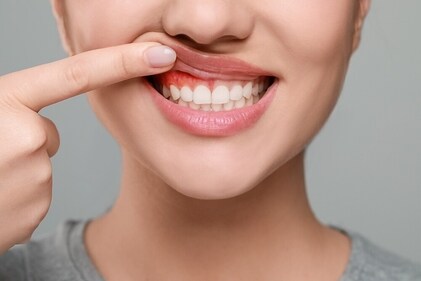 Brushing forcefully can lead to gum recession, exposing sensitive tooth roots and increasing decay risk. (Shutterstock) Brushing forcefully can lead to gum recession, exposing sensitive tooth roots and increasing decay risk. (Shutterstock)