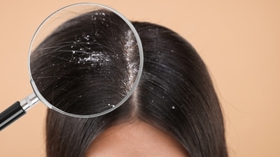 Don’t dismiss particles in your hair as just dandruff, because the treatment may differ. (Shutterstock) Don’t dismiss particles in your hair as just dandruff, because the treatment may differ. (Shutterstock)