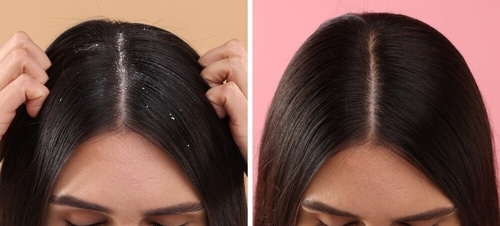 Dandruff, in contrast to a healthy scalp, looks like a dusting across the parting and shoulders, tiny white or yellowish flakes that shed easily on the shoulders. (Shutterstock) Dandruff, in contrast to a healthy scalp, looks like a dusting across the parting and shoulders, tiny white or yellowish flakes that shed easily on the shoulders. (Shutterstock)