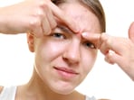 Popping a pimple is very tempting. Popping a pimple is very tempting.