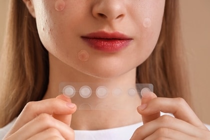 Choose pimple patches instead of popping them to prevent scarring of skin. (Shutterstock)