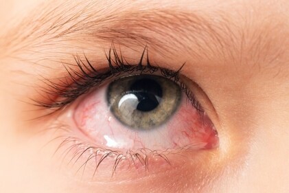 Conjunctivitis causes irritated, red, and watery eyes, and becomes more common during the monsoon. (Shutterstock) Conjunctivitis causes irritated, red, and watery eyes, and becomes more common during the monsoon. (Shutterstock)