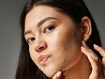 Hormonal imbalance results in acne.