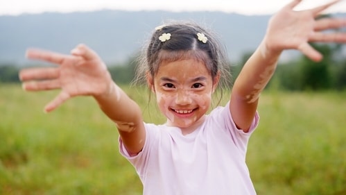 People with vitiligo are often subjected to negative judgments, social exclusion and outright poor treatment because there is a lack of awareness about this skin condition. (Shutterstock) People with vitiligo are often subjected to negative judgments, social exclusion and outright poor treatment because there is a lack of awareness about this skin condition. (Shutterstock)