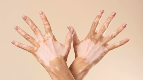 The condition can affect any part of the body, including the skin, hair, and mucous membranes. (Freepik)