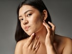 Obesity can lead to acne. Obesity can lead to acne.