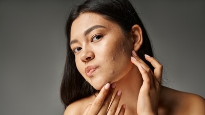 Obesity can lead to acne. (Shutterstock) Obesity can lead to acne. (Shutterstock)