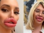 Spanish woman’s extreme lip transformation costs  <span class='webrupee'>₹</span>1.45 crore. 