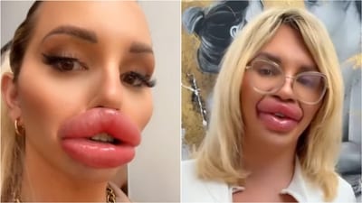 Spanish woman’s extreme lip transformation costs ₹1.45 crore. (Instagram/@viennaxtreme) Spanish woman’s extreme lip transformation costs ₹1.45 crore. (Instagram/@viennaxtreme)