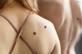 Here's how to distinguish between skin tags, moles and warts. (Freepik) Here's how to distinguish between skin tags, moles and warts. (Freepik)