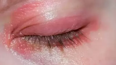 Rash around eyes can be caused by allergens. (Unsplash)