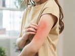 Skin allergies and infections are common because of the high moisture content in the air. Skin allergies and infections are common because of the high moisture content in the air.