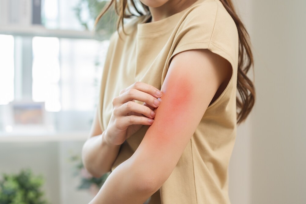 Skin allergies and infections are common because of the high moisture content in the air. (Shutterstock) Skin allergies and infections are common because of the high moisture content in the air. (Shutterstock)