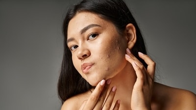Diet plays a crucial role in skin health, according to Dr. Karan. (Shutterstock) Diet plays a crucial role in skin health, according to Dr. Karan. (Shutterstock)
