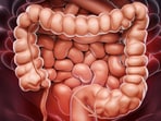 The top warning signs of colon cancer in younger people include 'retinal bleeding'. (Freepik)