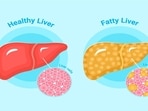 Dr Aasima Boxwalla shares that fatty liver disease isn't solely linked to weight.