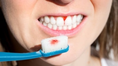 Your gums are a window into your body. Inflammation here means something bigger might be going on. (Shutterstock) Your gums are a window into your body. Inflammation here means something bigger might be going on. (Shutterstock)