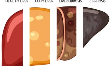 By taking care of your liver, you can reduce your risk of developing fatty liver disease and other liver-related problems. (Representative picture: Freepik) By taking care of your liver, you can reduce your risk of developing fatty liver disease and other liver-related problems. (Representative picture: Freepik)