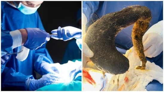 The hairy bezoar extracted from the woman’s stomach. (Pic courtesy: Freepik and Gizmodo.com/ Verdi Cevallos Balda General Hospital)