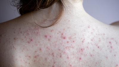 Back acne shows up in small, reddish bumps. (Shutterstock) Back acne shows up in small, reddish bumps. (Shutterstock)