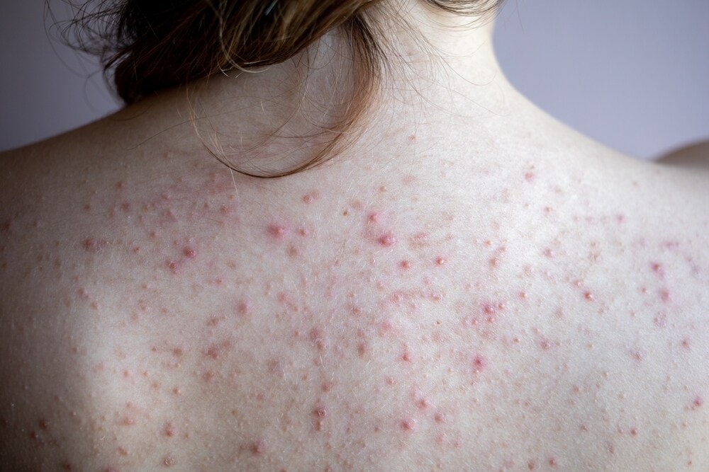 Fungal acne happens on the back too. (Picture credit: Shutterstock)