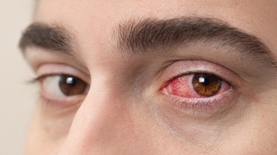 Eye infections are rising at a concerning rate this monsoon. (Shutterstock) Eye infections are rising at a concerning rate this monsoon. (Shutterstock)