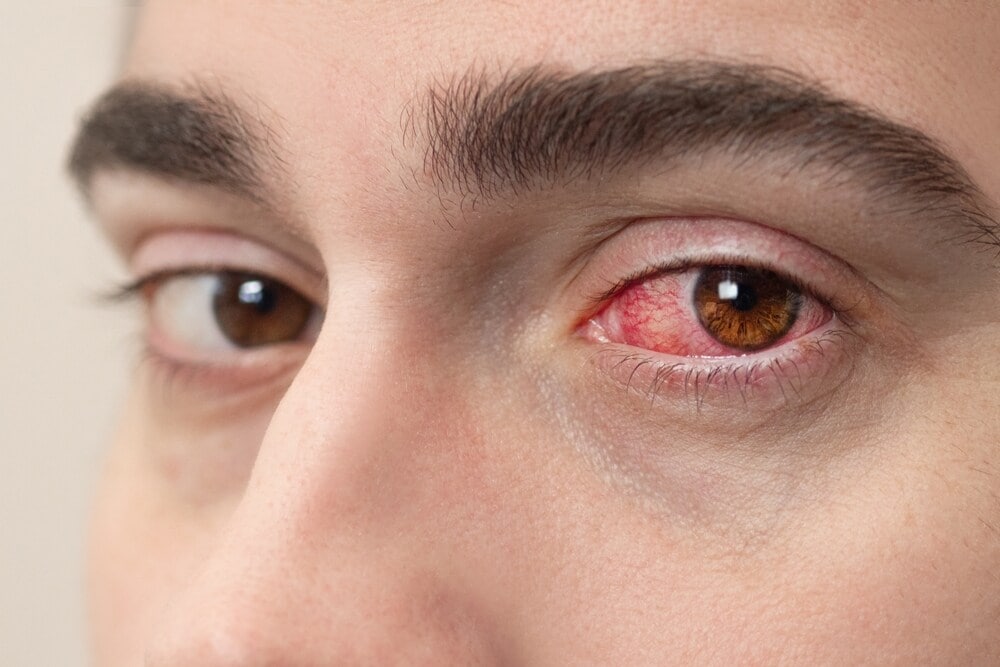 Do not try to self-treat any eye-related problems, like redness or itching. Visit a doctor instead. (Shutterstock)